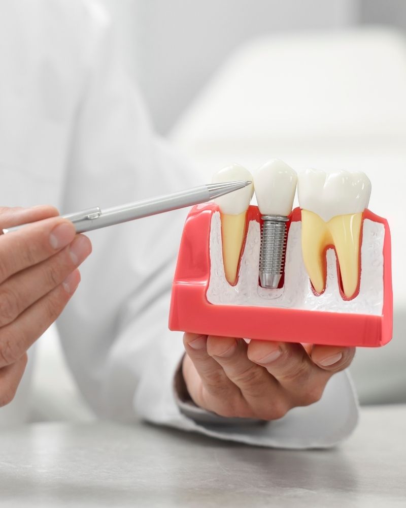dental implants in hadapsar dental implants in hadapsar