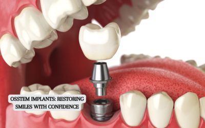 Osstem Implants: Restoring Smiles with Confidence