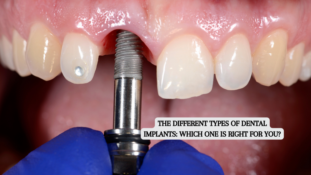 Types of Dental Implants: Which One Is Right for You?