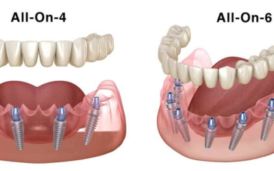 All 4 Implants or 6 Implants…Which Full Mouth Implant Suits You?…