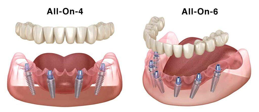 All 4 Implants or 6 Implants…Which Full Mouth Implant Suits You?…