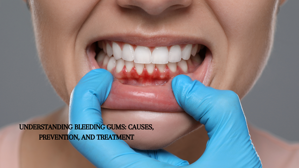 Understanding Bleeding Gums: Causes, Prevention, and Treatment