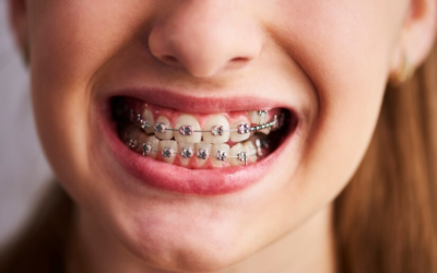 Orthodontic Braces to Fix Teeth Alignment Issues