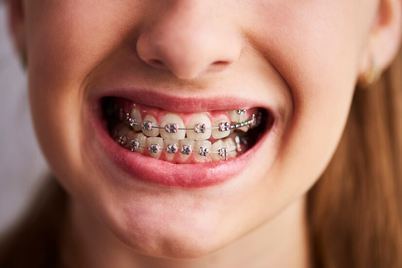 Orthodontic Braces to Fix Teeth Alignment Issues