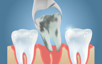 Precautions to Take After Wisdom Teeth Removal